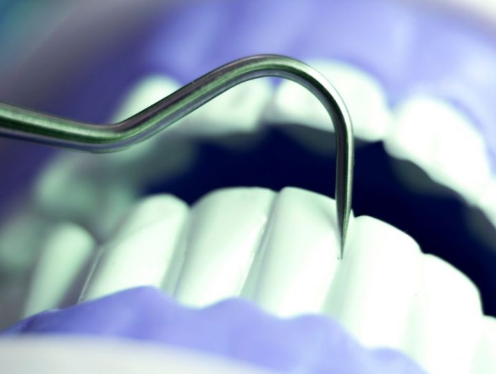 Root Canal Treatment