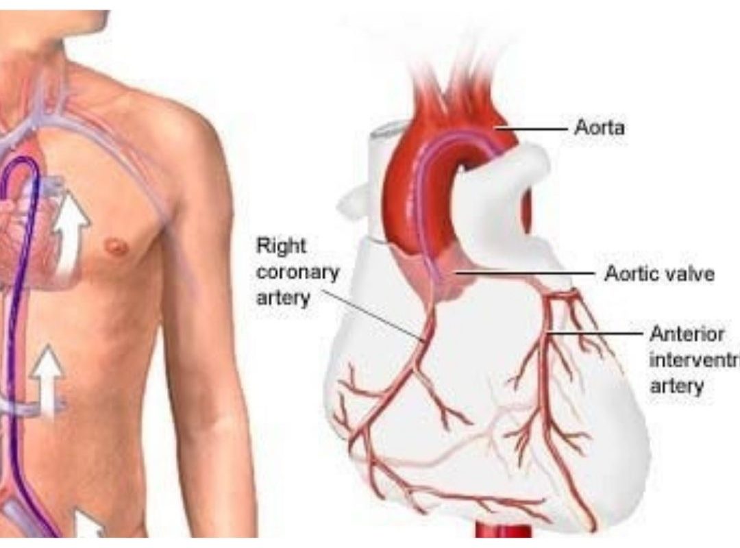 Coronary Angiography