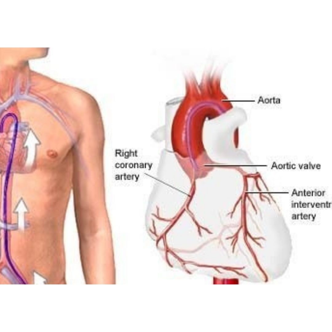 Coronary Angiography